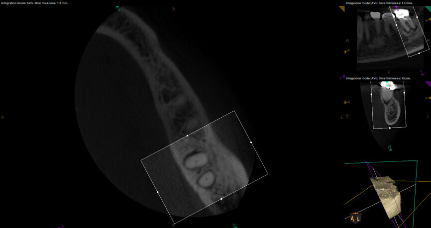 Fig. 17d: Case assisted with CBCT to determine anatomy pre-operatively. Note the multiple cross sections moving apically and the correlation to the 2-D view. Note also the conservative taper in relation to the root width. (Courtesy of Dr. Brett Gilbert)