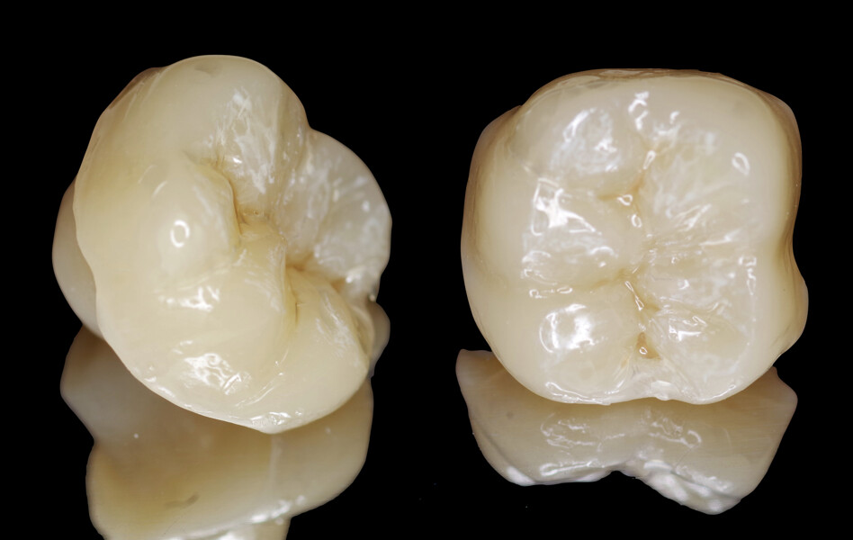 Fig. 16: Occlusal surface of the finished endocrown.