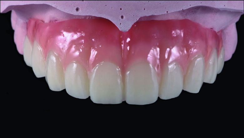 Fig 16. Ceramage GUM light (GUM-L) was applied in order to imitate the free gingival area.