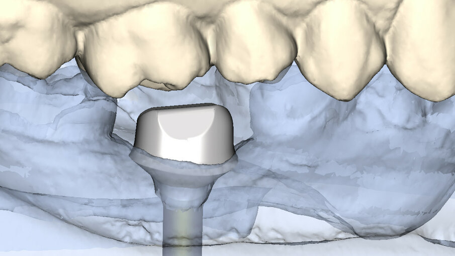 Fig. 10: The Atlantis abutment was virtually designed with the
emergence width of the replaced molar and manufactured in titanium with a titanium nitride coating.
