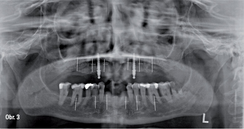 OPG snímek po prvním chirurgickém zákroku s plánováním pozic pro implantáty
