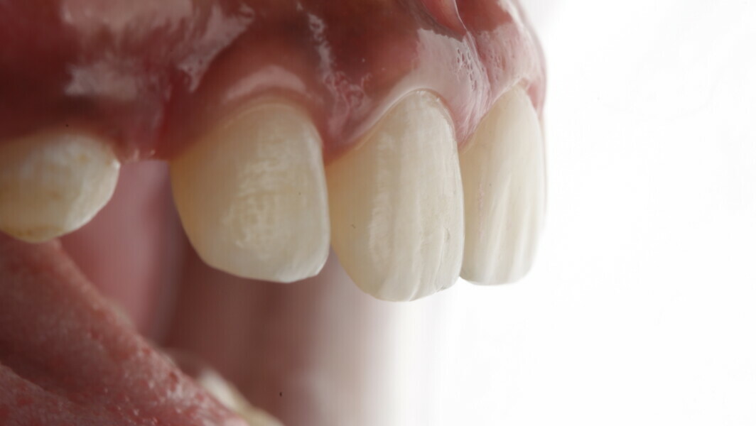 Fig 41: Note the natural integration of the composite resin with the dental tissue.