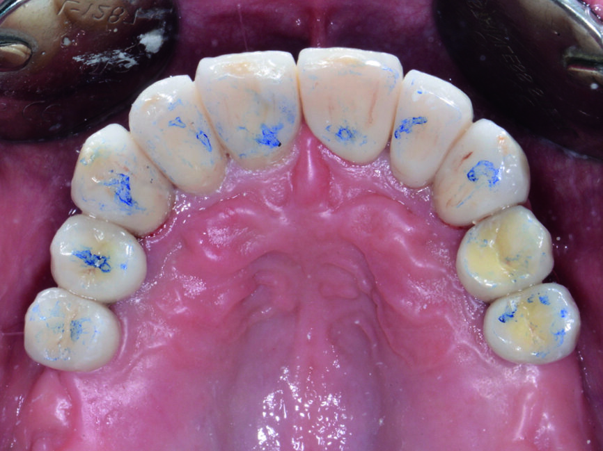 Fig. 22 : Vérification fonctionnelle de l’occlusion au niveau de l’arcade maxillaire. 