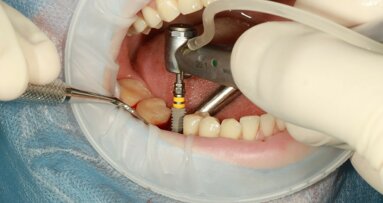 Review study compares machined and sandblasted dental implant surfaces