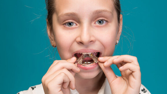 Studie belegt Entstehung von Zahnfehlstellungen im Kindesalter