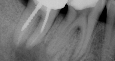3-D imaging and endodontics: educated guess becomes scientific decision