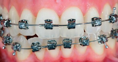 Salivary biomarkers to monitor orthodontic treatments biologically