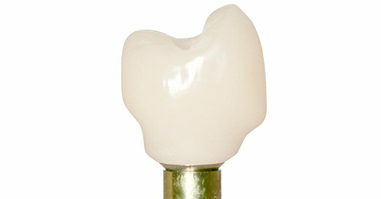 Corona implantosoportada de cerámica híbrida CAD/CAM