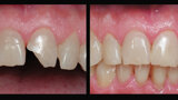 Imágenes de la restauración realizada por el Dr. Joubert antes y después del procedimiento.