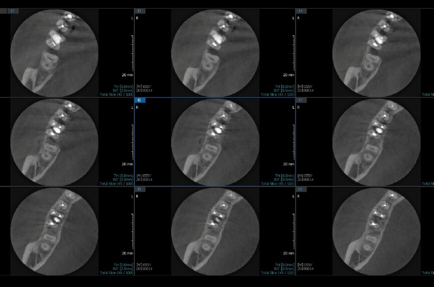 Fig. 6f: Post-op CBCT images of tooth #46 showing adequately obturated canals at all levels to the working length and sealing of the furcation defect.