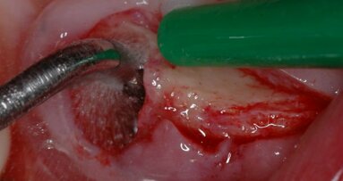 Chirurgia implantare minimamente invasiva nel paziente geriatrico a rischio