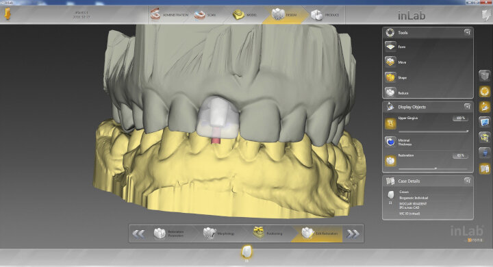 Fig. 6: Planning the shape and size of the future CAD/CAM full ceramic crown in cut-back technique in the inLab software (Dentsply Sirona) based on the Atlantis Core File received.