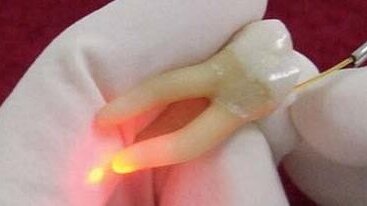 Przeciwbakteryjne działanie laserów w leczeniu endodontycznym