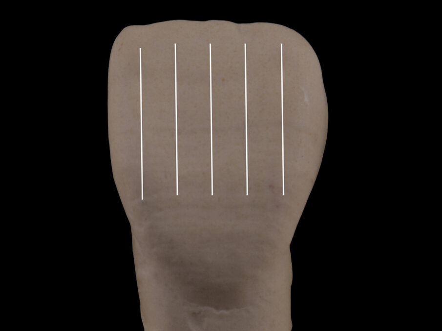Fig. 7 - Linee verticali distanti creano un’espansione equilibrata della configurazione del dente.