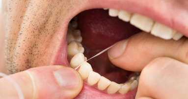 Effizienz von Zahnseide: EFP-Stellungnahme zu aktuellen Berichten