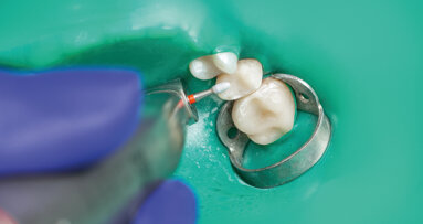 Protection du patient en odontologie – Le cadre à digue de seconde génération