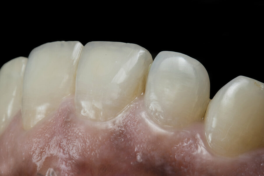 Fig. 16: Frontal view of maxillary anterior teeth showcasing bio mimetic aesthetics of composite resin with a close match to natural tooth translucency and effects in the incisal area