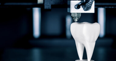 Les avantages de l'impression 3D en interne pour la pose immédiate d'implants dentaires