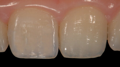 Moving beyond classical shade guides to achieve natural restorations