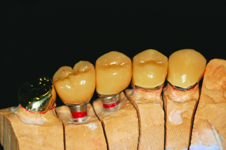 Fig. 13: Implant case