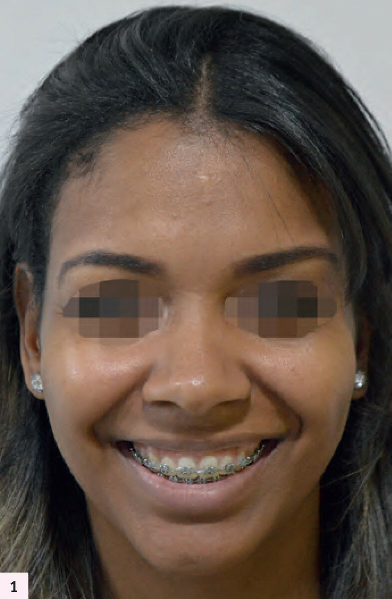 Fig. 1 : La patiente présente un sourire gingival.