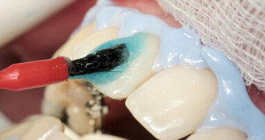 Bělení zubů a ortodoncie: třešnička na dortu