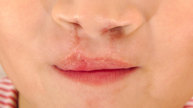 NAM bei Lippen-Kiefer-Gaumenspalte: Nutzen unklar
