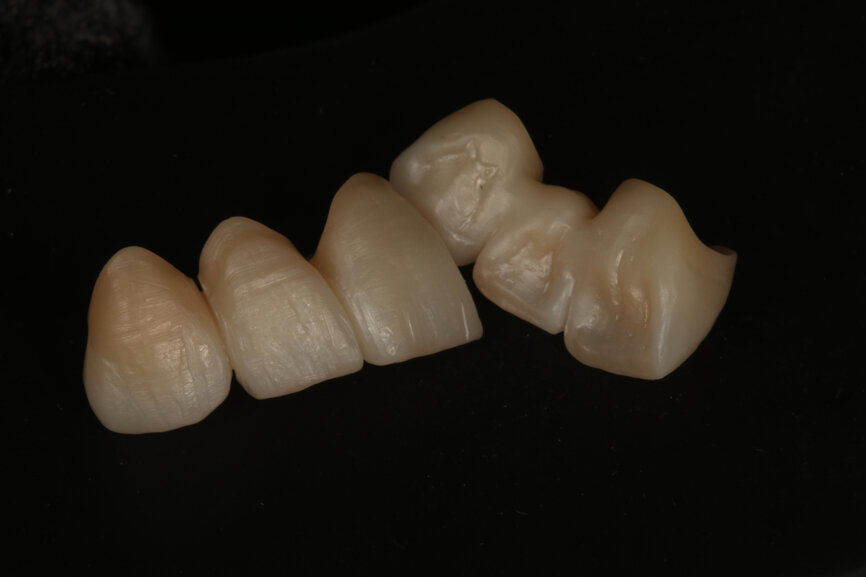 Fig. 10: Appearance of the restorations immediately after sintering.