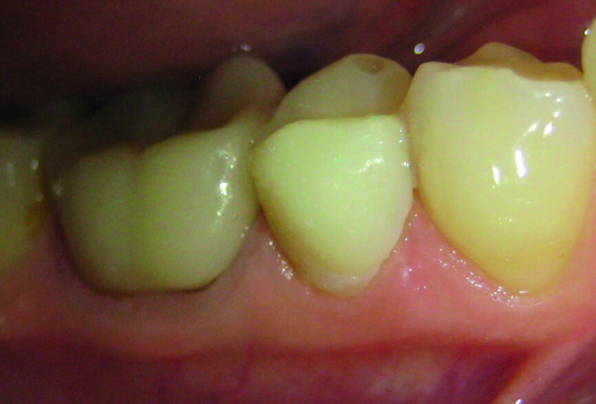 Fig. 6: Temporary crown on tooth #45 set in the mouth.