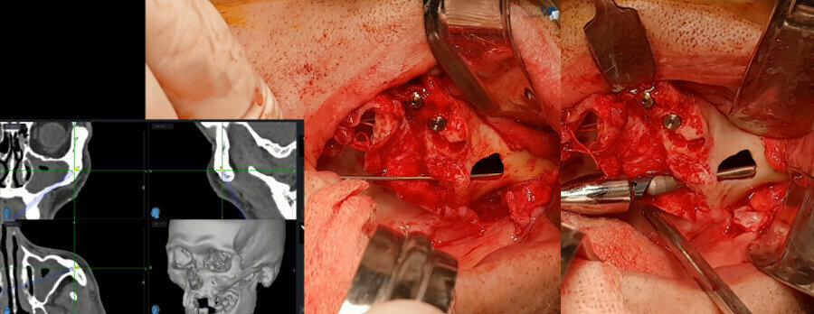 Figs. 7a & b: Placement of the second-quadrant zygomatic implant with the help of the navigation instrument.