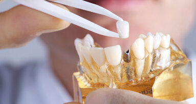 Türk Bilim İnsanından Dental İmplant Tedavisinde Yeni Buluş