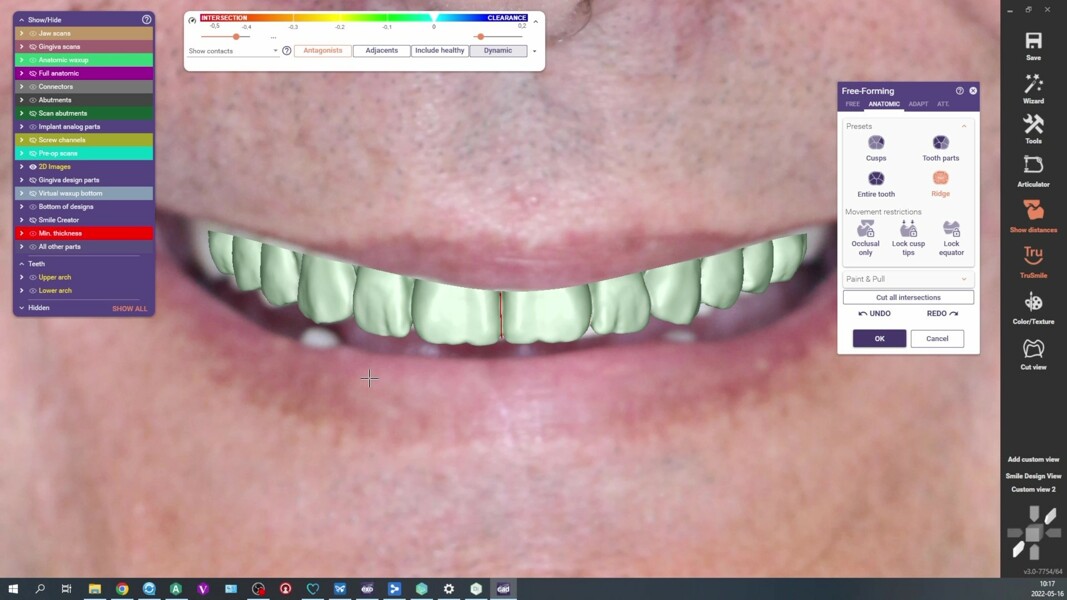 Fig. 15: CAD view of the designed prosthesis in the context of the patient’s smile.