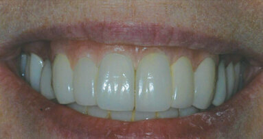 Utilizing the ERA over-denture implant to create soft-tissue symmetry in the esthetic zone