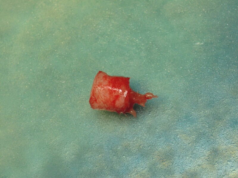 Fig. 23 : Prélèvement en tubérositaire d‘une carotte ostéo-gingivale.