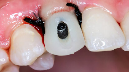 Study compares immediate with early and conventional loading of dental implants