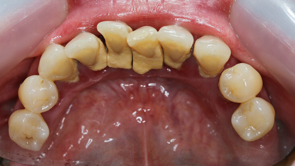 A doença periodontal aumenta o risco de doenças crônicas, incluindo problemas de saúde mental