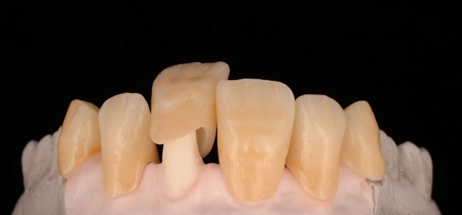 Fig. 24: Fitting the GC Initial LiSi Press restoration on to the zirconia framework.