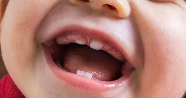 New study on primary dentition takes first steps toward early autism diagnosis