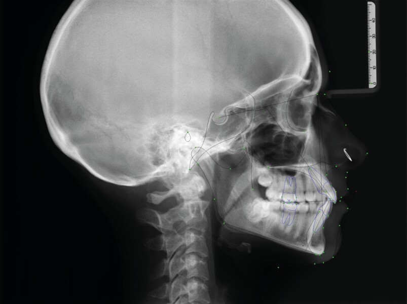 Fig. 8a : radiographie céphalométrique initiale 