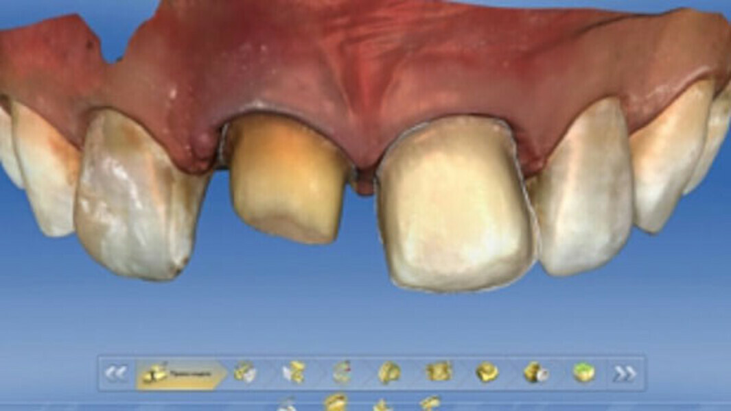 Fig. 4. Los límites de la preparación en los dientes 11 y 21 se establecieron en el software CEREC.