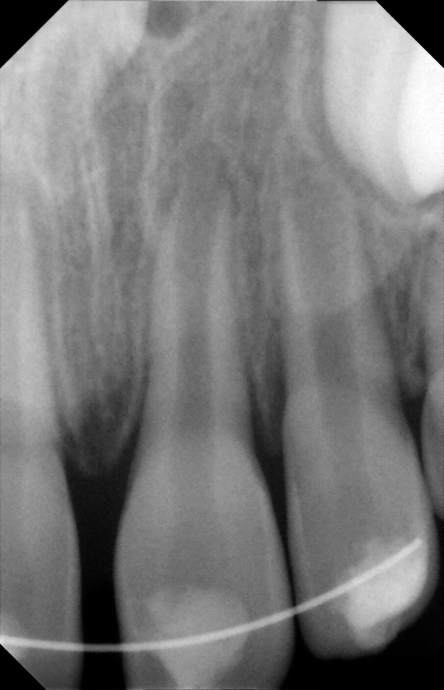 Figure 11: A peripical radiograph taken one week post-op showed the correct positioning of the replanted tooth. Note the open apex.