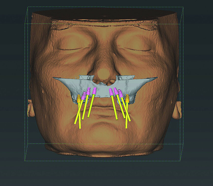 Fig. 5: Dentofacial analysis of proposed implants in maxillary arch.