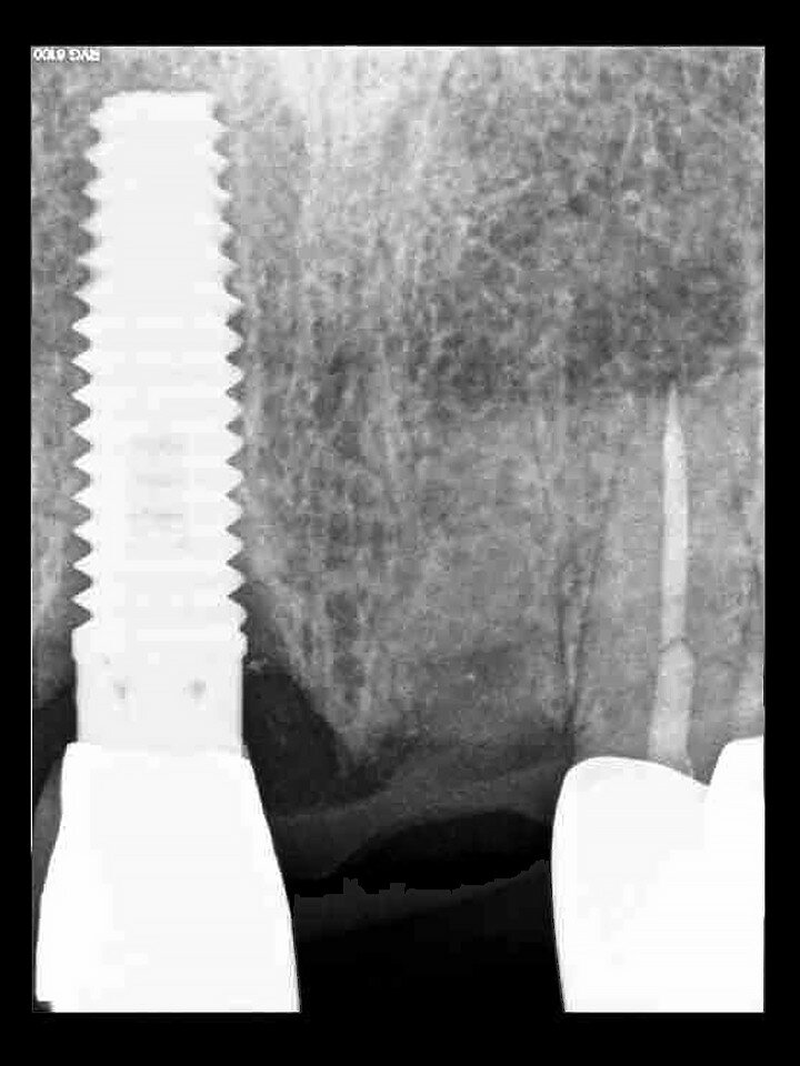 Fig. 21: A periapical radiograph confirmed that the palatal root and all the gutta-percha had been completely removed.
