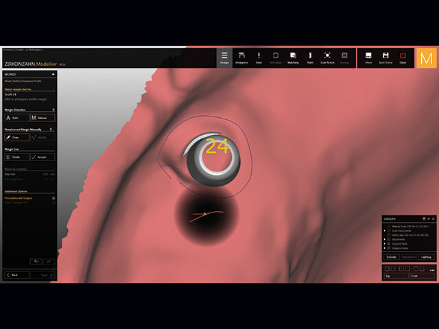 Za účelem individuálního navržení oblasti kolem implantátů je možné zakreslit emergence profil jednotlivě.