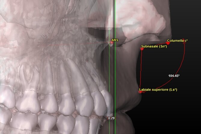 Fig. 13_Ricostruzione 3D di un soggetto che presenta il margine incisale degli incisivi superiori (punto UIm) a livello della spina nasale anteriore e contestualmente un angolo naso-labiale corretto.