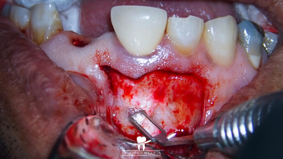 Fig. 12: Retro-obturation of tooth #11 during periapical surgery using CeraPutty.