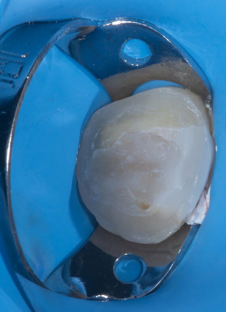 Fig. 7: Tooth after preparation, leaving a relatively flat, non-retentive surface.