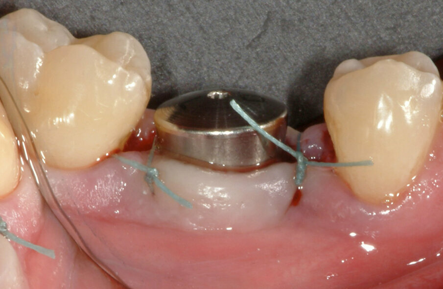 Fig. 8: A 7 mm healing abutment was placed to guide the soft tissue to an optimal healing situation.