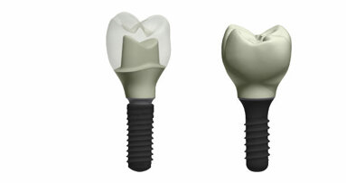 3Shape integrates Straumann abutments into CAD software