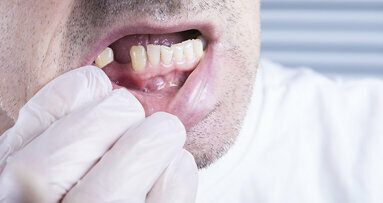 FDI releases new guidelines on treating partially dentate patients